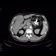 Cholangiocellular carcinoma: CT - Computed tomography